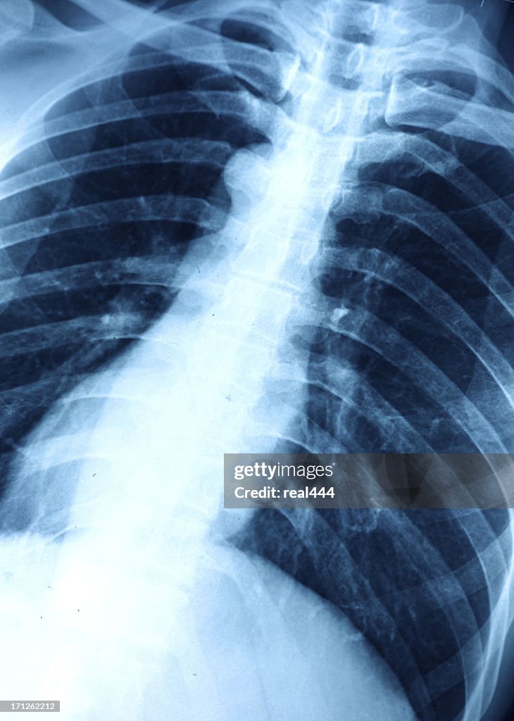 Chest X-ray image