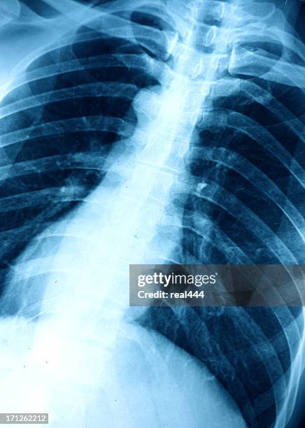 X Ray Ribs Rug 126 X Ray Rib Cage Stock Photos, High-Res Pictures, and Images - Getty ...