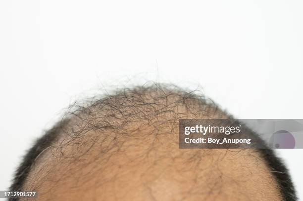 cropped shot view of asian men's scalp with few hairs. baldness is related to your genes and male sex hormones. - tapered roots stock pictures, royalty-free photos & images