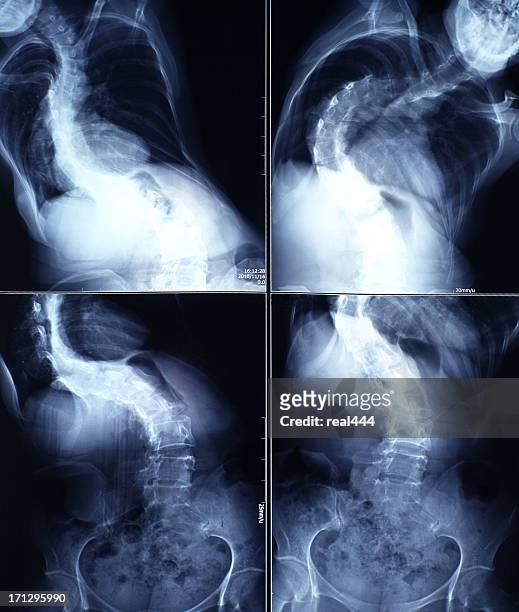x-ray image human spine - skolios bildbanksfoton och bilder