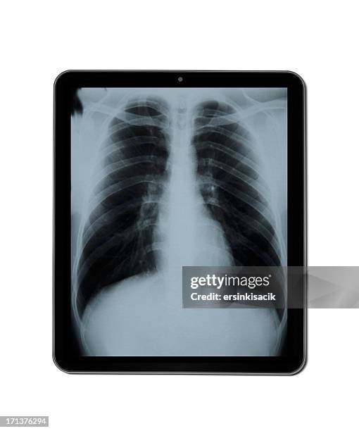 x-ray on tablet pc - respiratory failure stock pictures, royalty-free photos & images