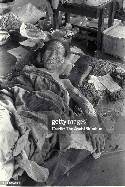 An atomic bomb surviver, who suffers serious burns onto her face and an arm by Nagasaki atomic bomb, lies for a treatment at temporary hospital set...