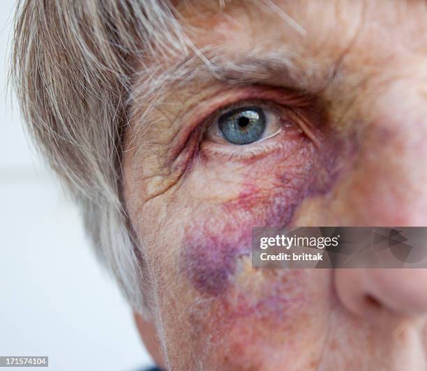 battered senior woman. close up of black eye. - mishandeling stockfoto's en -beelden