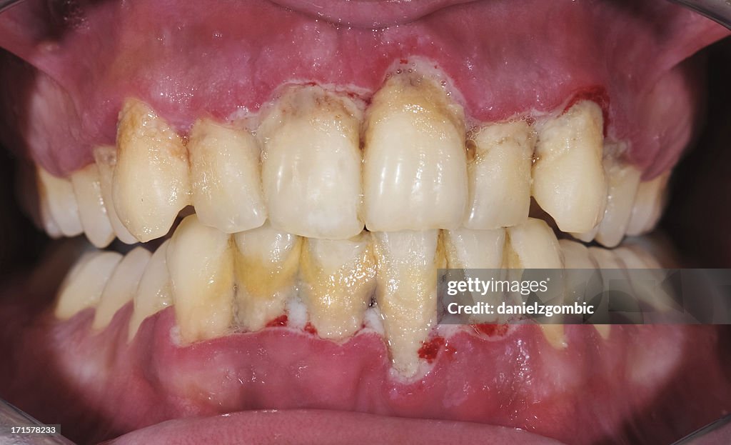 Periodontitis