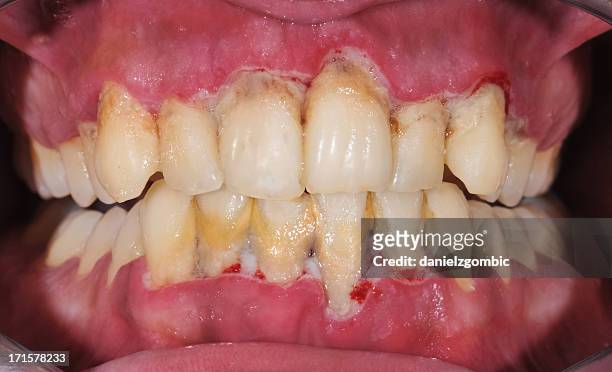 periodontitis - ontsteking medische aandoening stockfoto's en -beelden