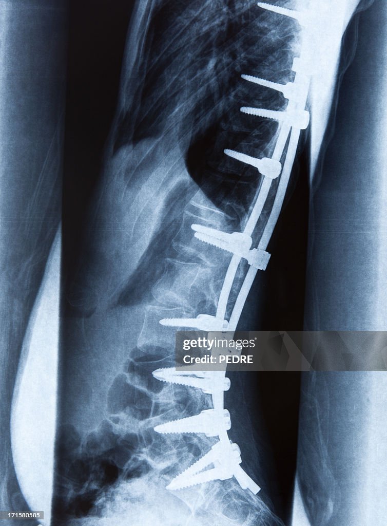 Spondylolisthesis