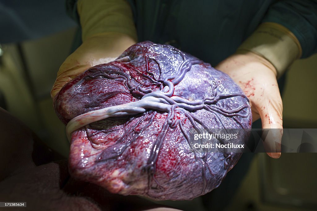 Doctor showing placenta just after childbirth