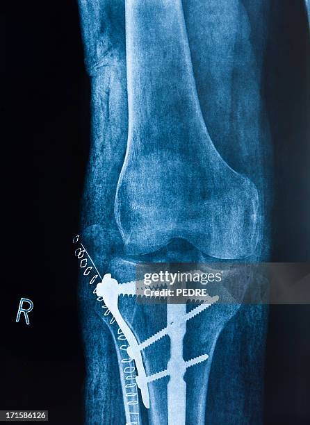 broken leg - tibia stock pictures, royalty-free photos & images