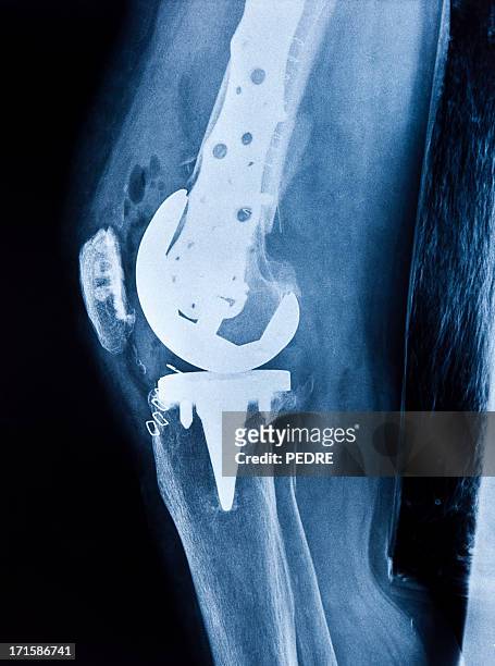 joelho de reposição total - knee replacement surgery - fotografias e filmes do acervo