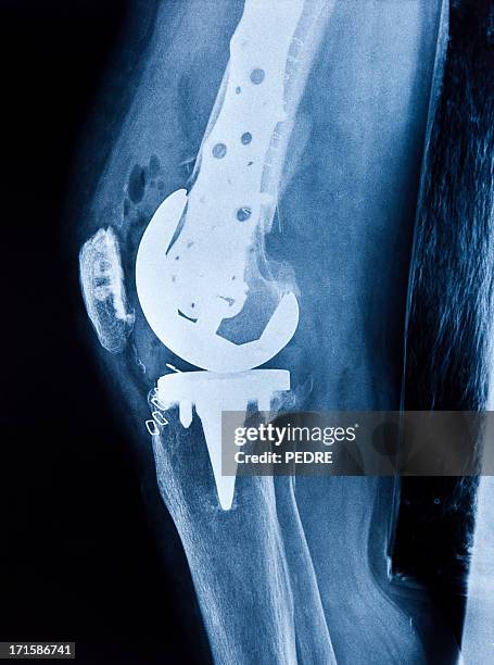 total knee replacement - knee replacement surgery 個照片及圖片檔