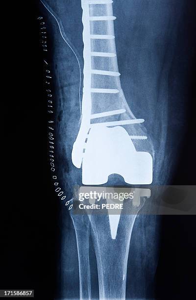 insgesamt knie erneuerung - knee replacement surgery stock-fotos und bilder