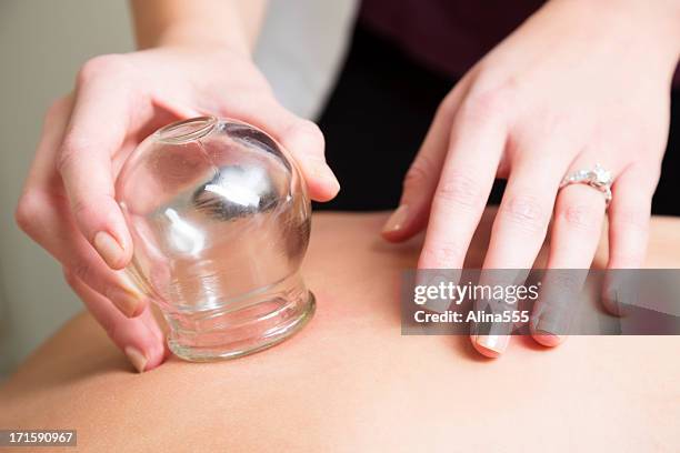 aupuncturist performs massage cupping therapy - cupping stockfoto's en -beelden