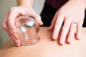 Aupuncturist performs massage cupping therapy