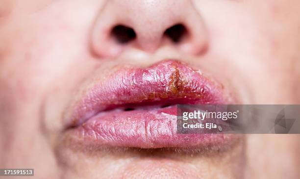 herpes simplex mündlichen-infektion - cold sore stock-fotos und bilder