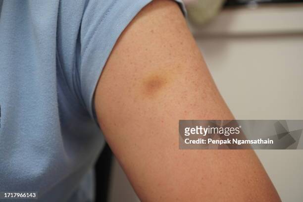 red bruise on woman's upper arm - bruised finger stock-fotos und bilder