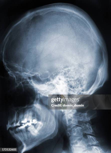 x-ray image of skull, brain and cervical spine, blue toned - skull xray no brain stock pictures, royalty-free photos & images