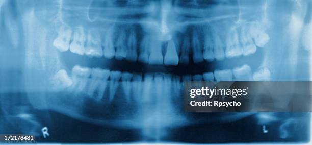 dental x-ray - root canal procedure stock-fotos und bilder