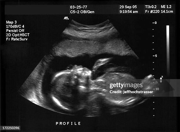 ultra-som - ultrasound scan - fotografias e filmes do acervo