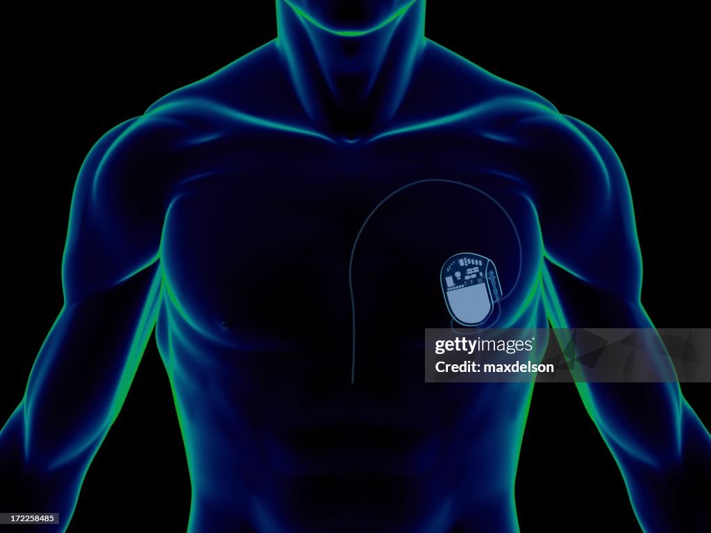 Foto Pacemaker Pacemaker Sul Petto Foto stock - Getty Images