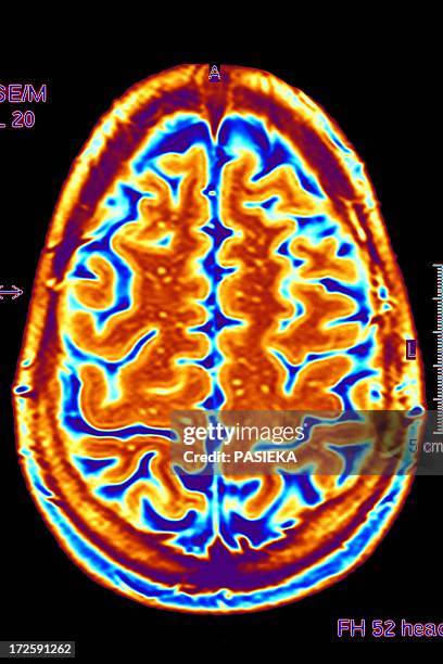 Healthy Brain Scan Photos and Premium High Res Pictures - Getty Images