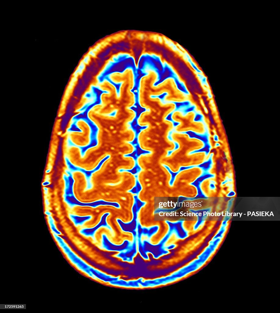 Brain scan, MRI scan
