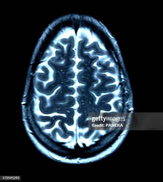 brain scan, mri scan - mri scan stock pictures, royalty-free photos & images