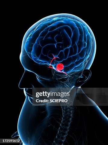 Brain aneurysm, artwork Brain aneurysm, artwork