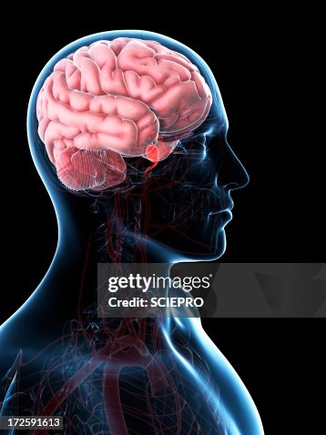 Brain aneurysm, artwork Brain aneurysm, artwork