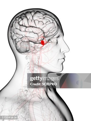 Brain aneurysm, artwork Brain aneurysm, artwork