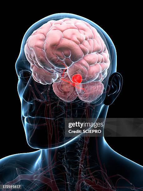 brain aneurysm, artwork - aneurysm stock illustrations