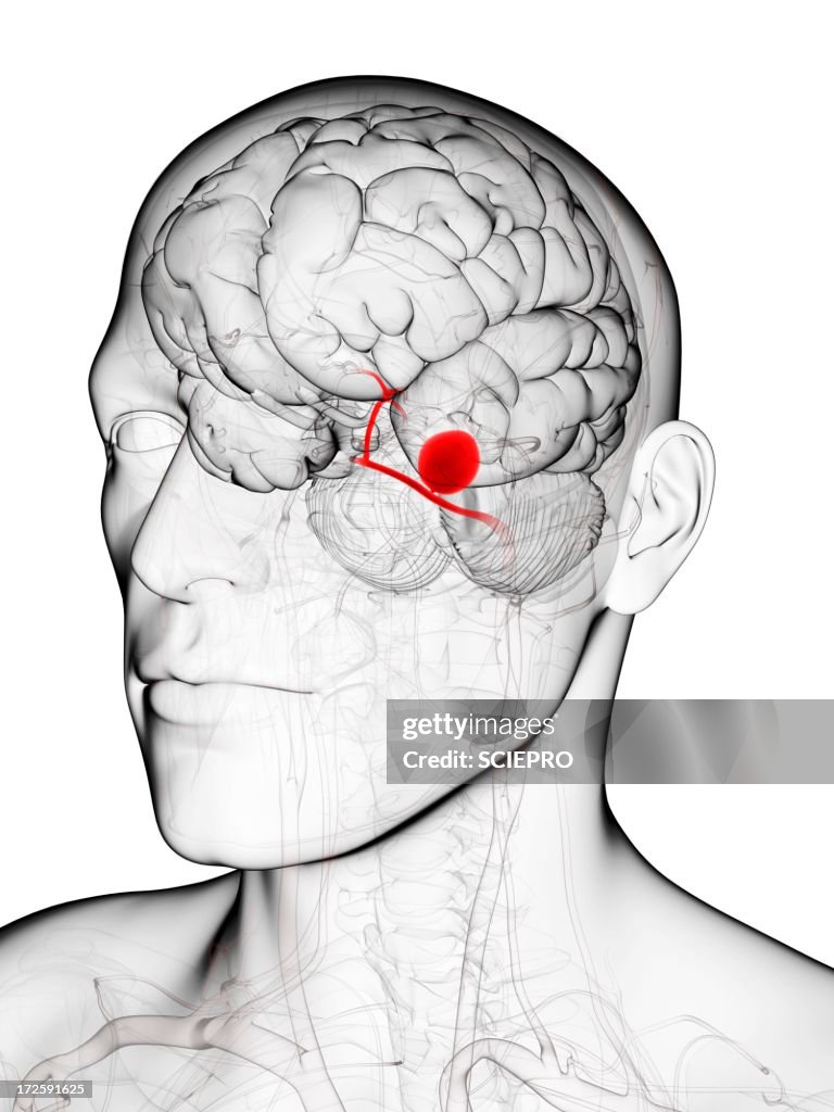 Brain aneurysm, artwork