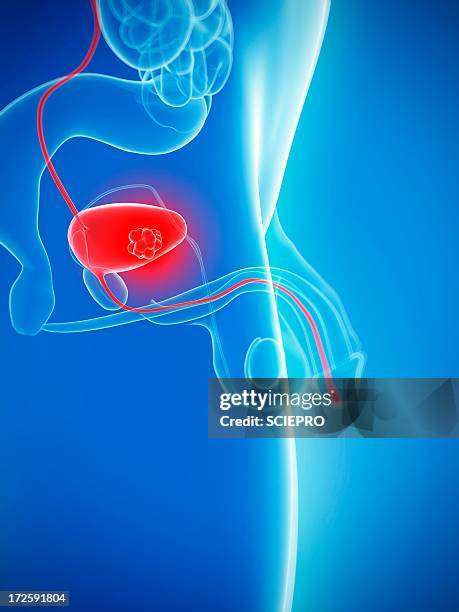 bladder cancer, artwork - bladder cancer stock illustrations