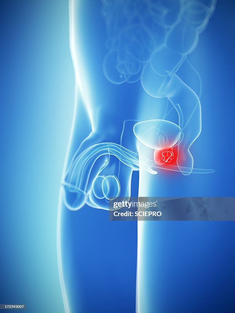 Prostate cancer, artwork