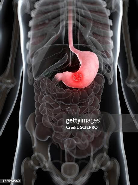 stomach cancer, artwork - stomach cancer stock illustrations