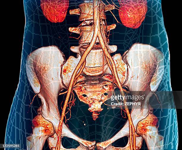 abdominal aorta, 3d ct scan - ct angiography stock pictures, royalty-free photos & images