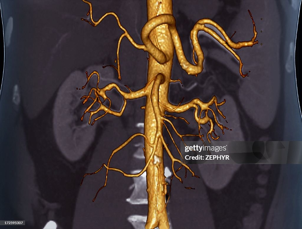 Abdominal aorta, 3D CT scan