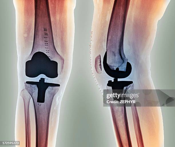 total knee replacement, x-rays - knee replacement surgery foto e immagini stock