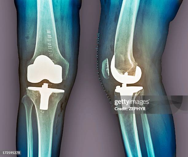 total knee replacement, x-rays - knee replacement surgery foto e immagini stock