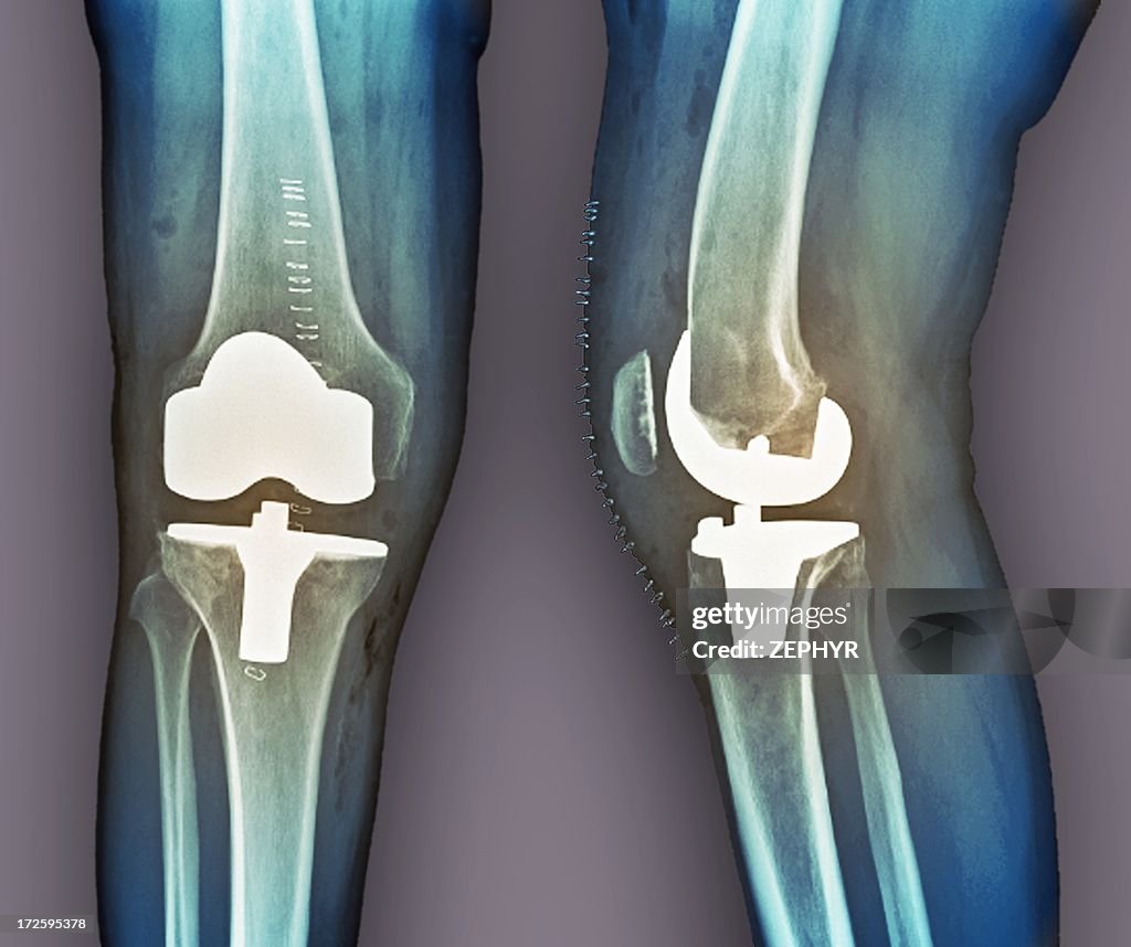 Total knee replacement, X-rays