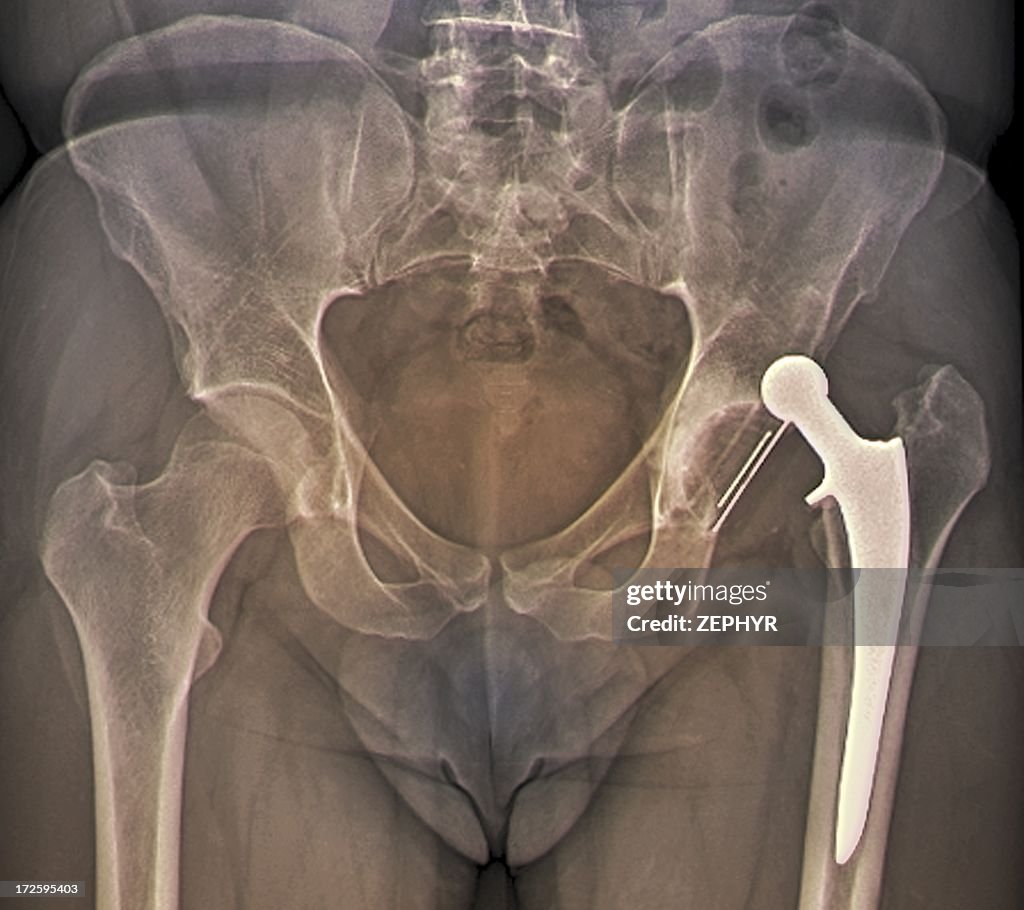 Dislocated hip replacement, X-ray