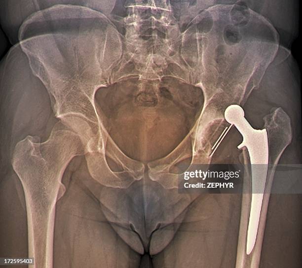 dislocated hip replacement, x-ray - hip surgery stock pictures, royalty-free photos & images