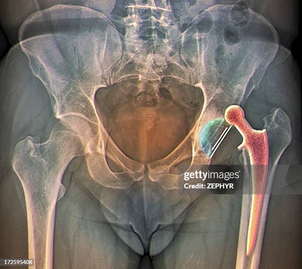 dislocated hip replacement, x-ray - hip surgery stock pictures, royalty-free photos & images