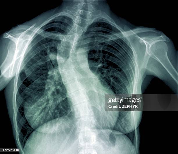 scoliosis of the spine, x-ray - scoliosis - fotografias e filmes do acervo