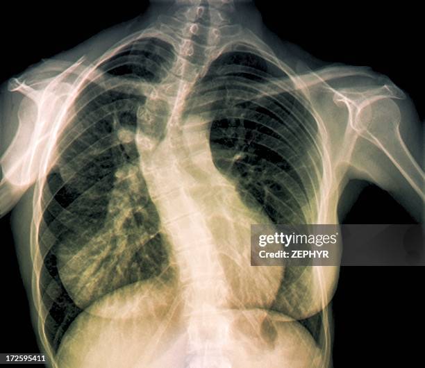 scoliosis of the spine, x-ray - skolios bildbanksfoton och bilder