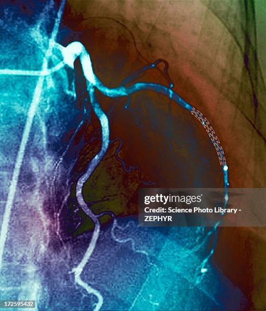 coronary stent, x-ray - stent stockfoto's en -beelden