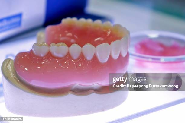teeth model showing an implant crown bridge model. dental demonstration teeth study teach model. - dentures stock pictures, royalty-free photos & images