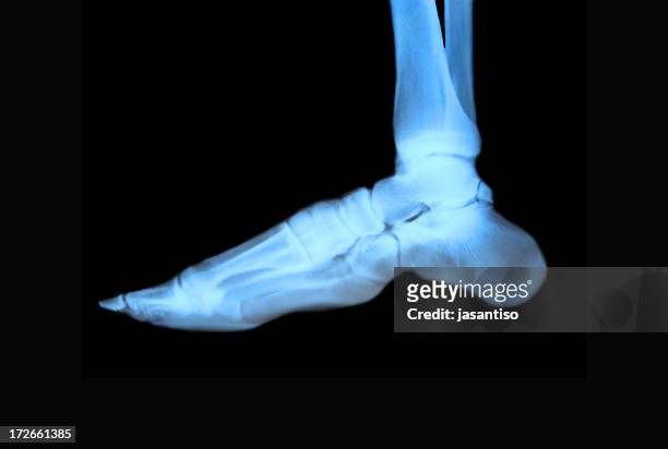 anatomie. pied - broken heel photos et images de collection