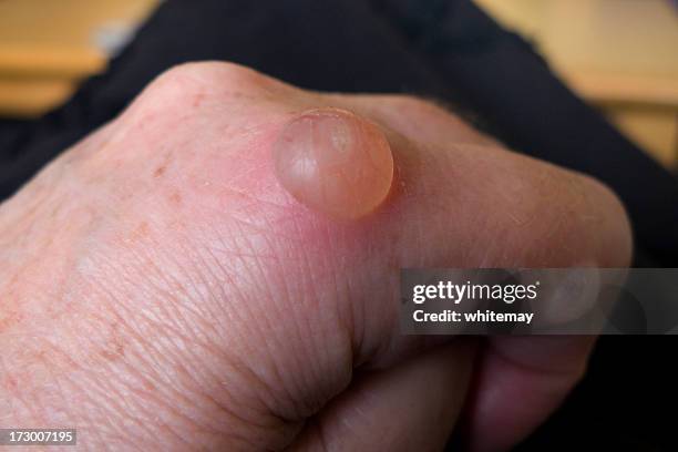 blister series - knuckles stock pictures, royalty-free photos & images