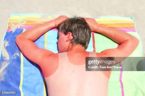 adult male with sunburnt vest mark - sunburn stock-fotos und bilder