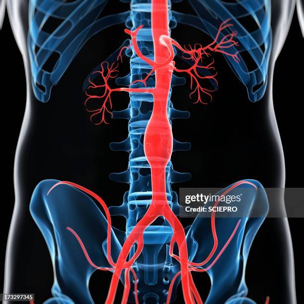 ilustrações, clipart, desenhos animados e ícones de aortic aneurysm, artwork - aorta